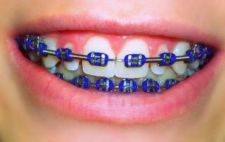 Braces