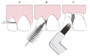 Interdental Cleaners