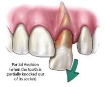 Partial Avulsion