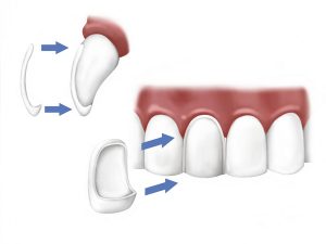 Porcelain Veneers