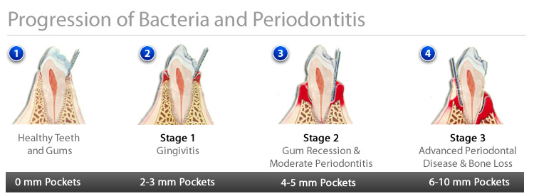 Progression of Gum Disease