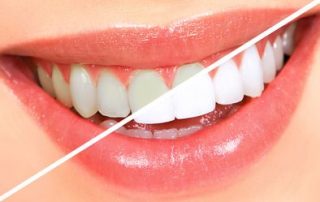 Teeth Whitening Miles City MT